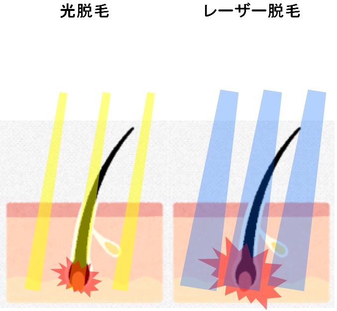 光脱毛とレーザー脱毛
